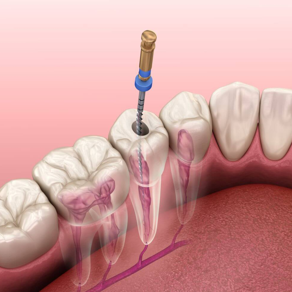 Dental Braces Treatment in Mahalaxmi Nagar Indore